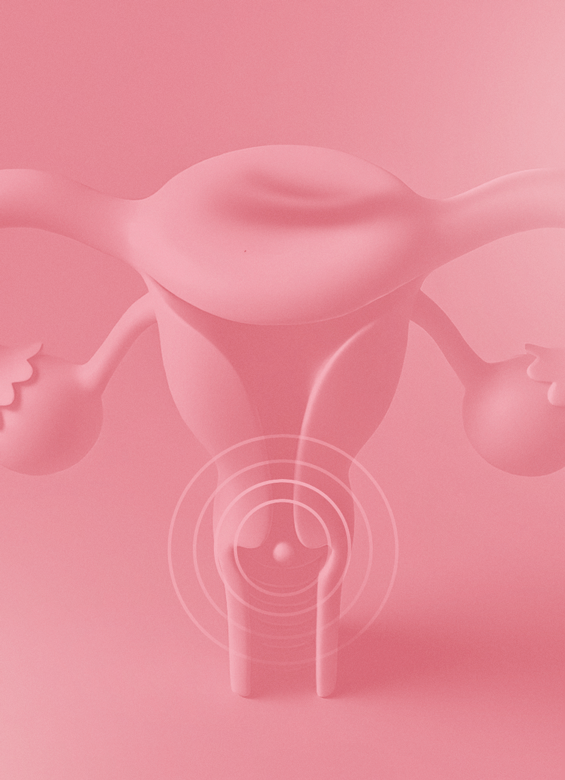 Retirada de Pólipo Cervical